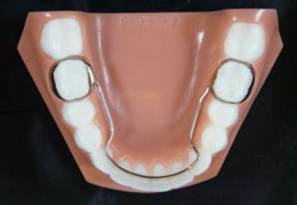 lower lingual holding arch