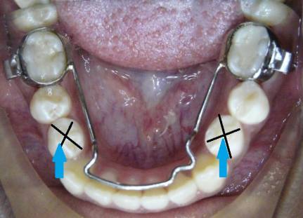 lower lingual holding arch