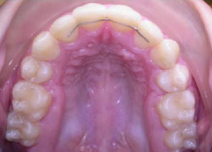 bump behind front teeth bottom jaw Couples friendly strip clubs