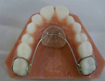 lower lingual holding arch