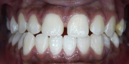 lower lingual holding arch